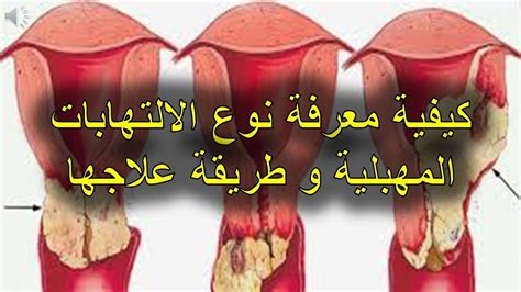 أعراض التهابات نسائية أعراض التهابات نسائية