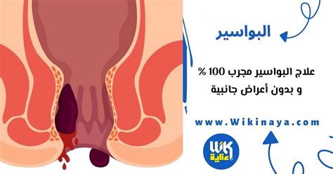 علاج البواسير مجرب 100 علاج البواسير مجرب 100