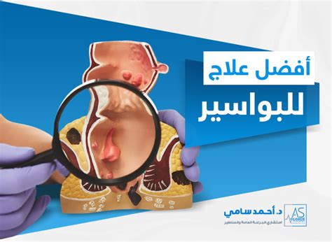 علاج البواسير نهائيا علاج البواسير نهائيا