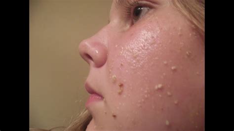 ظهور حبوب في الظهر بعد الزواج ظهور حبوب في الظهر بعد الزواج