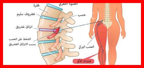 اسباب عرق النسا اسباب عرق النسا
