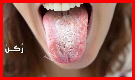 اسباب فطريات اللسان اسباب فطريات اللسان