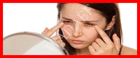 اسباب هالات العين اسباب هالات العين