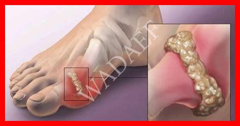 اسباب يوريك اسيد اسباب يوريك اسيد