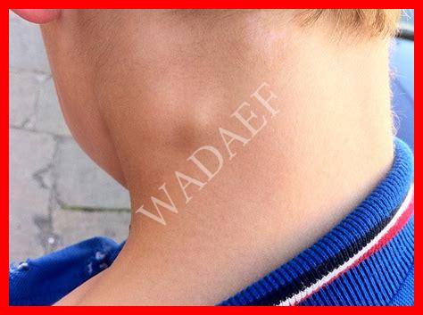 حبة في الرقبة تحت الجلد تتحرك حبة في الرقبة تحت الجلد تتحرك