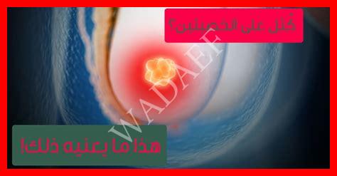 حبة في جلد الخصية حبة في جلد الخصية