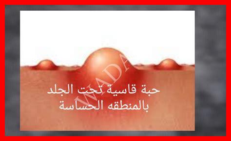 حبة في جلد الراس حبة في جلد الراس