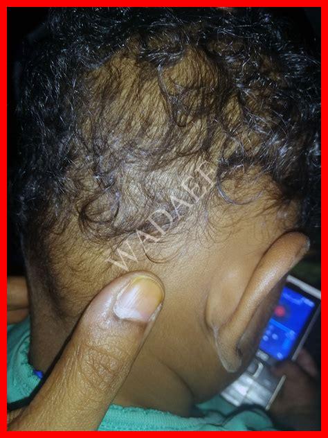 حبة في عين الطفل حبة في عين الطفل