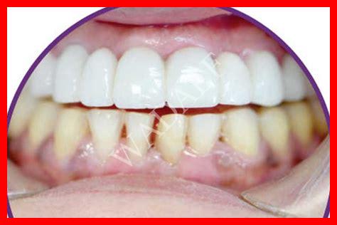 حبة في لثة حبة في لثة