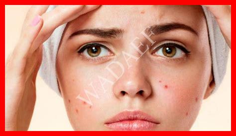 حبة في وجه حبة في وجه