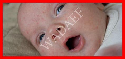 حبة في وجه الرضيع حبة في وجه الرضيع
