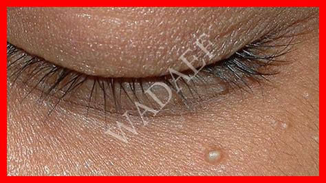 حبة في وجه طفلي حبة في وجه طفلي