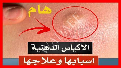حبة قيح في الثدي حبة قيح في الثدي
