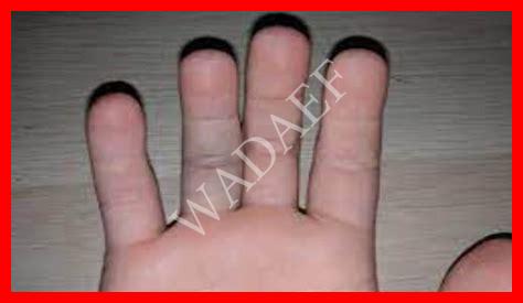 حبه في اصبع يدي حبه في اصبع يدي