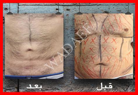 دكتور شفط الدهون في مراكش دكتور شفط الدهون في مراكش