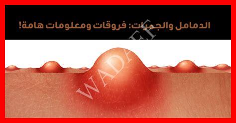 سبب ظهور حبة في المؤخرة سبب ظهور حبة في المؤخرة