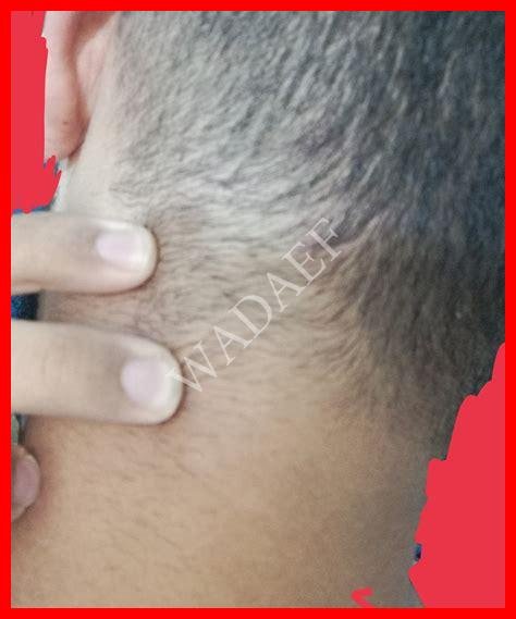 ظهور حبة في الراس ظهور حبة في الراس