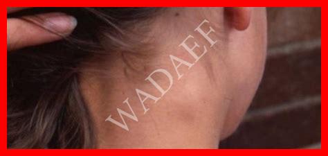 ظهور حبة في الرقبة ظهور حبة في الرقبة