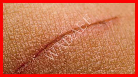 علامات شفاء الجروح علامات شفاء الجروح