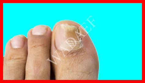 فطريات الاظافر اسباب فطريات الاظافر اسباب