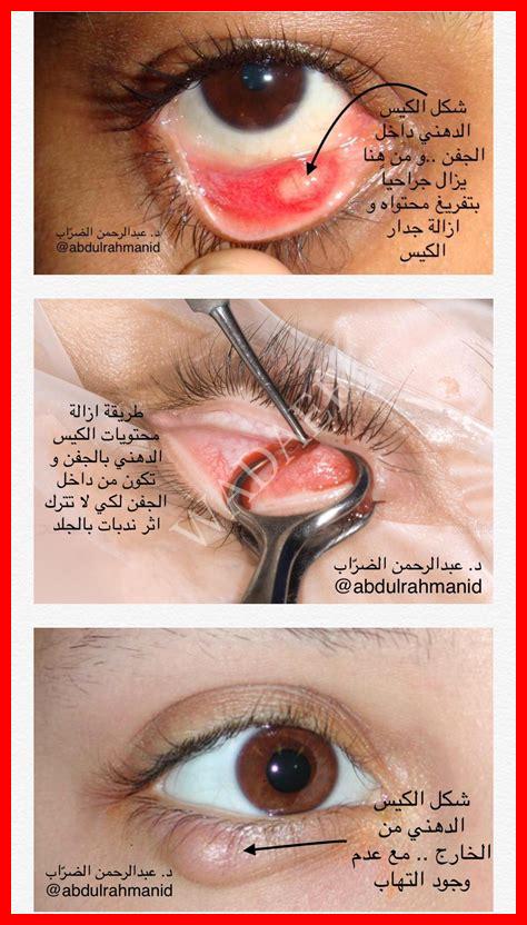 وجود حبة في المهبل وجود حبة في المهبل