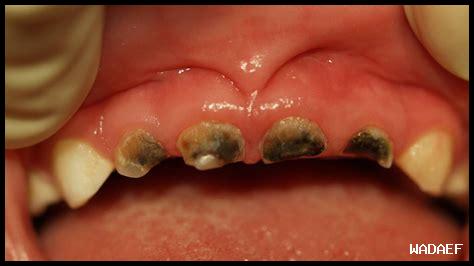 أسباب تصبغ الأسنان وكيفية معالجتها