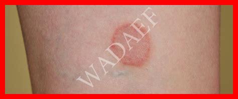 أنواع الحزاز بالصور