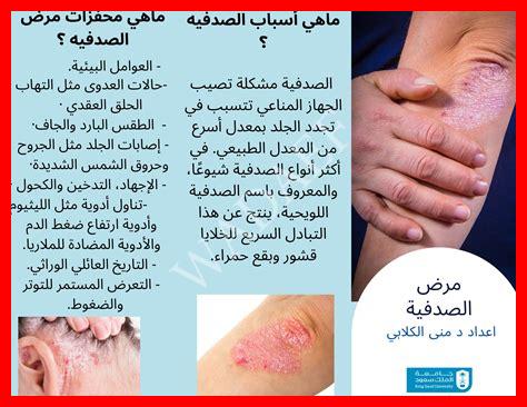أنواع الصدفية بالصور