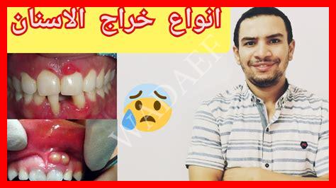 أنواع خراج الأسنان