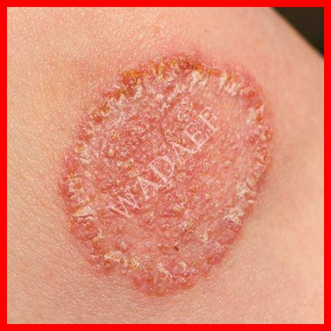 أنواع فطريات الشعر بالصور أنواع فطريات الشعر بالصور