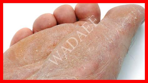 أنواع فطريات الشعر بالصور أنواع فطريات الشعر بالصور