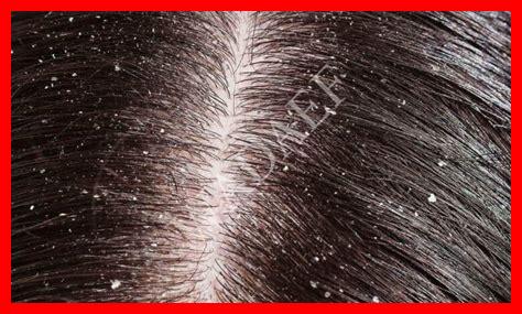 أنواع قشرة الشعر بالصور