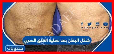انقاص حجم البطن انقاص حجم البطن