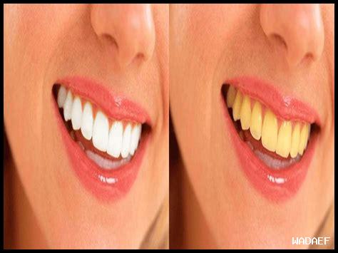 تبيض الأسنان بالخل: هل هو فعال؟