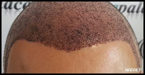 تبيض الأسنان بمسحوق الصودا: هل هو آمن؟