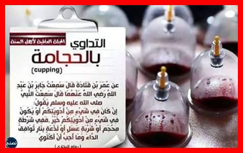 جامعت زوجتي بعد الحجامة جامعت زوجتي بعد الحجامة