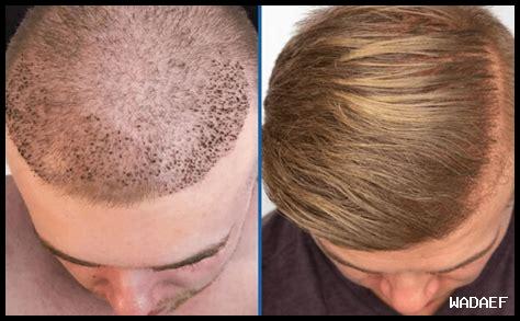 زراعة الشعر بالرباط