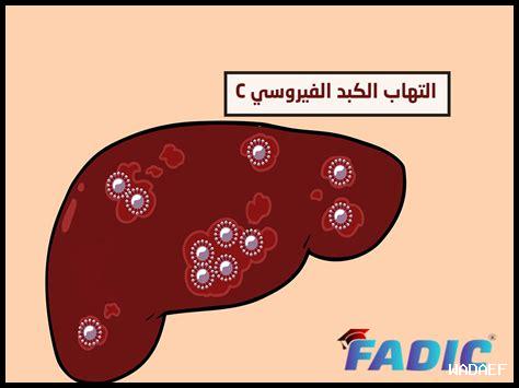 زوجي مصاب بالتهاب الكبد الوبائي ب