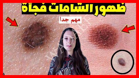 سبب زيادة ظهور الشامات