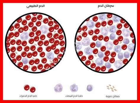 سرطان الدم أنواع سرطان الدم أنواع