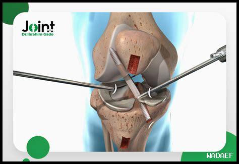 غضروف الرباط الصليبي