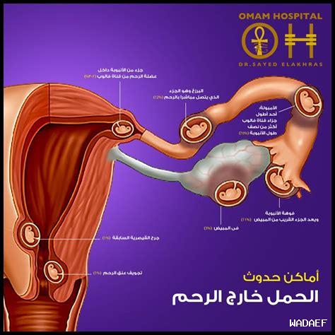 كيف أتعامل مع مشاكل الحمل خارج الرحم؟ كيف أتعامل مع مشاكل الحمل خارج الرحم؟