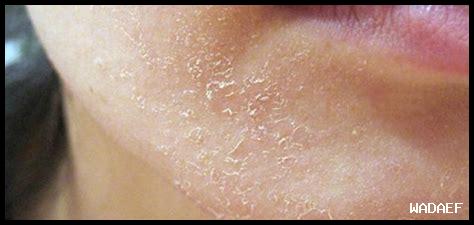 كيف أتعامل مع تصبغات البشرة الناتجة عن الشمس