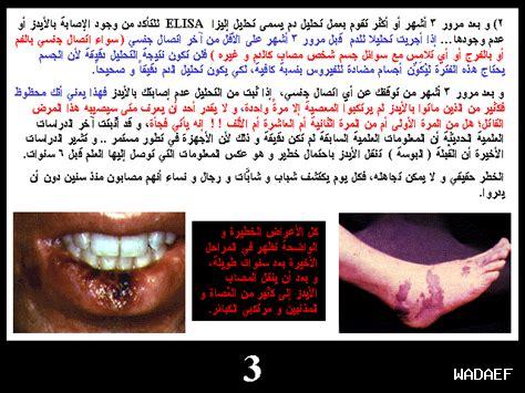 كيف يؤثر فالسارتان على مرضى الإيدز؟ كيف يؤثر فالسارتان على مرضى الإيدز؟