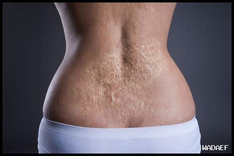 كيف يمكن استخدام باراسيتامول في علاج الحروق؟