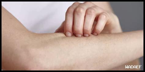 ما هو تأثير هيدروكورتيزون على الأكزيما؟