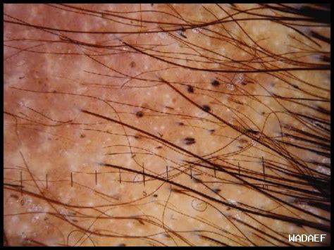 نقط سوداء في البراز