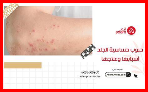 هل سيتريزين مناسب للحساسية الجلدية؟ هل سيتريزين مناسب للحساسية الجلدية؟