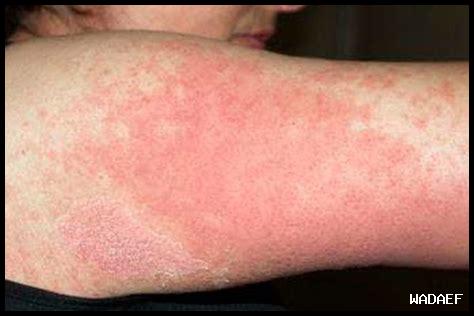 هل سيرترالين يسبب طفح جلدي