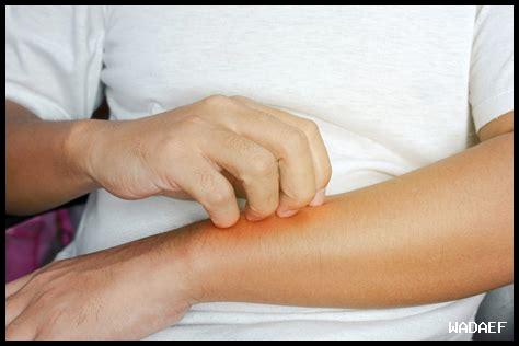 هل يمكن استخدام هيدروكورتيزون في علاج لدغات الحشرات؟
